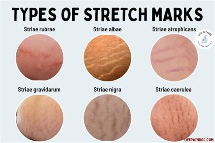 Understanding Stretch Marks: Types, Stages & Treatment